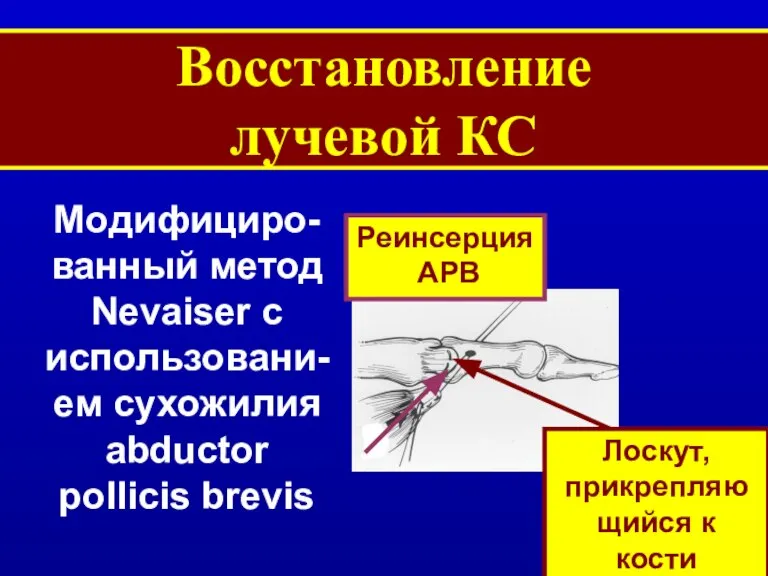 Восстановление лучевой КС Модифициро-ванный метод Nevaiser с использовани-ем сухожилия abductor pollicis brevis