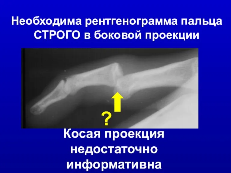 Необходима рентгенограмма пальца СТРОГО в боковой проекции Косая проекция недостаточно информативна