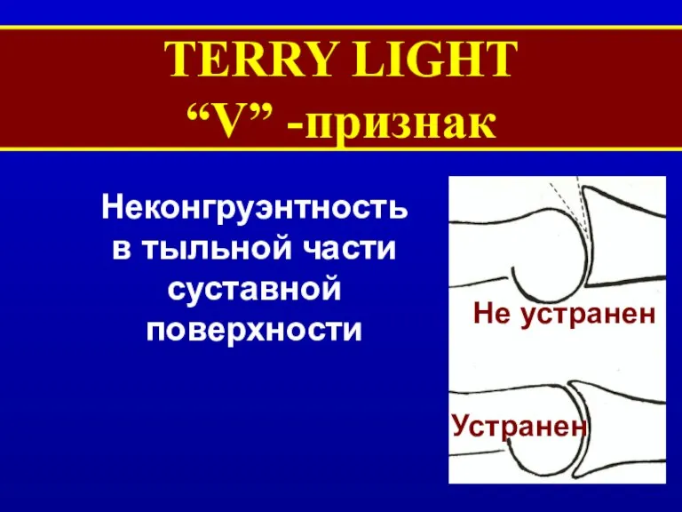 TERRY LIGHT “V” -признак Неконгруэнтность в тыльной части суставной поверхности Не устранен Устранен