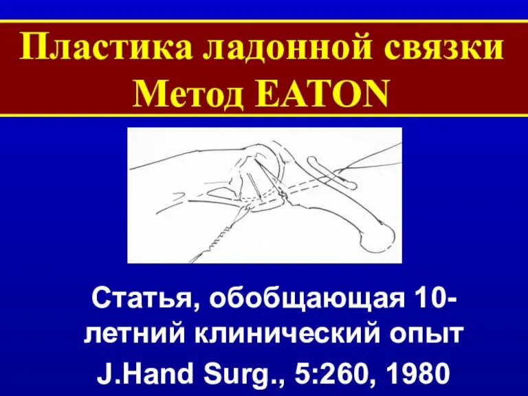 Пластика ладонной связки Метод EATON - Статья, обобщающая 10-летний клинический опыт J.Hand Surg., 5:260, 1980