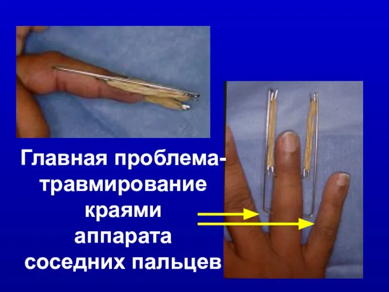 Главная проблема- травмирование краями аппарата соседних пальцев