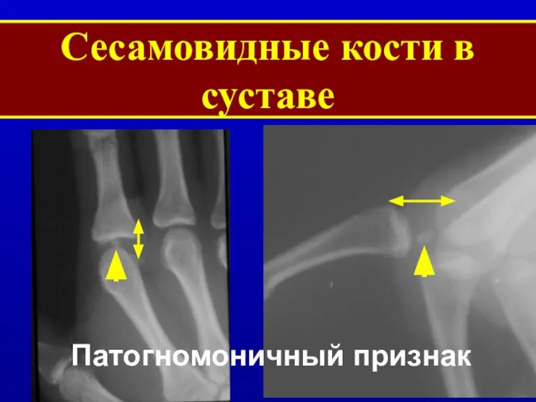Сесамовидные кости в суставе Патогномоничный признак