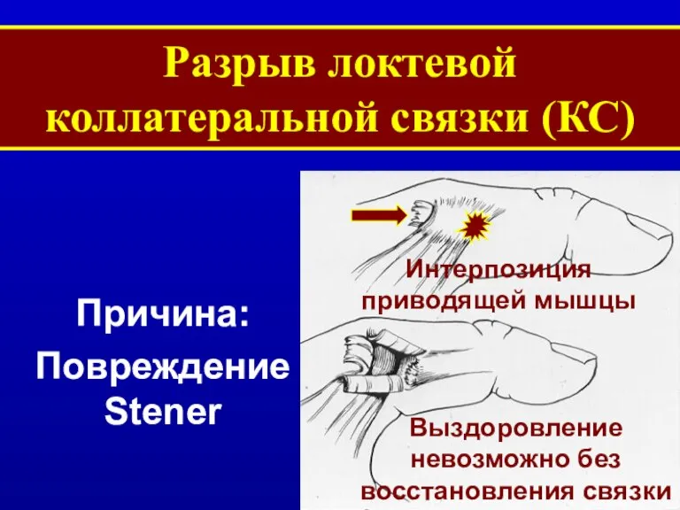 Разрыв локтевой коллатеральной связки (КС) Причина: Повреждение Stener Интерпозиция приводящей мышцы Выздоровление невозможно без восстановления связки