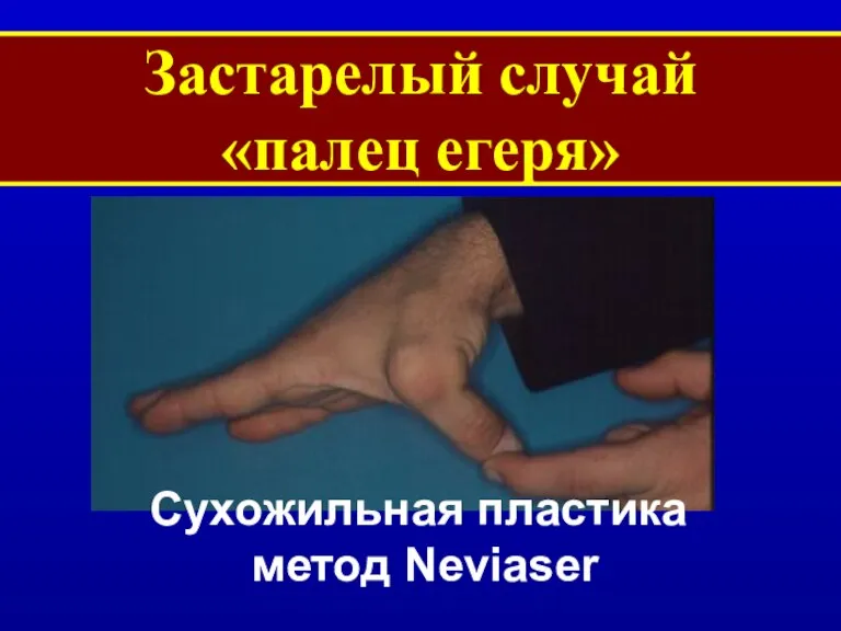 Застарелый случай «палец егеря» Сухожильная пластика метод Neviaser