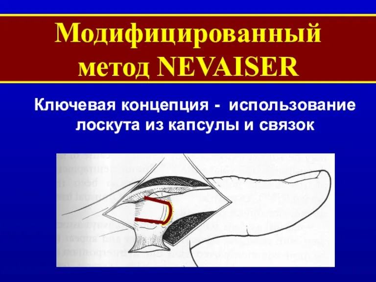 Модифицированный метод NEVAISER Ключевая концепция - использование лоскута из капсулы и связок