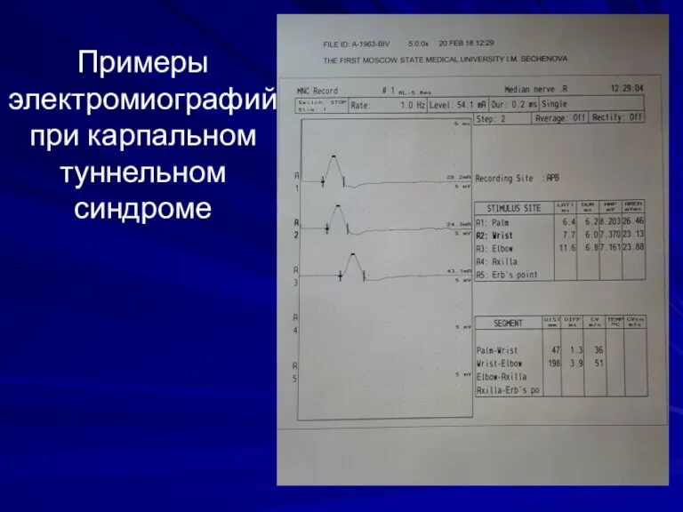 Примеры электромиографий при карпальном туннельном синдроме