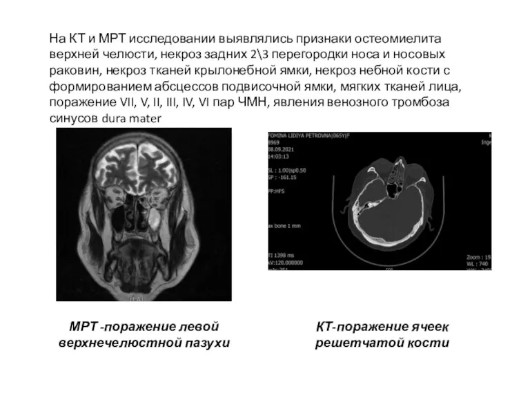 На КТ и МРТ исследовании выявлялись признаки остеомиелита верхней челюсти, некроз задних