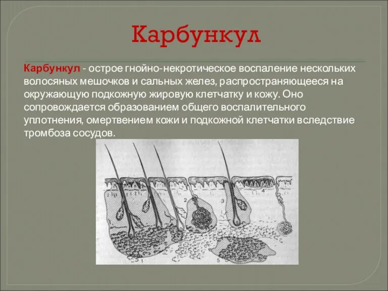 Карбункул Карбункул - острое гнойно-некротическое воспаление нескольких волосяных мешочков и сальных желез,