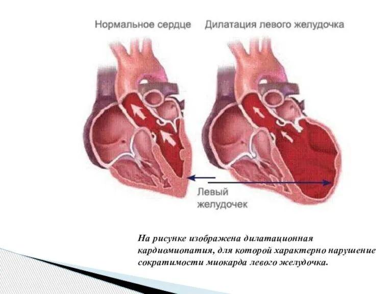 На рисунке изображена дилатационная кардиомиопатия, для которой характерно нарушение сократимости миокарда левого желудочка.
