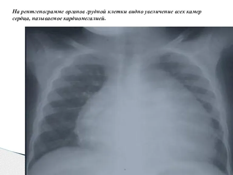 На рентгенограмме органов грудной клетки видно увеличение всех камер сердца, называемое кардиомегалией.
