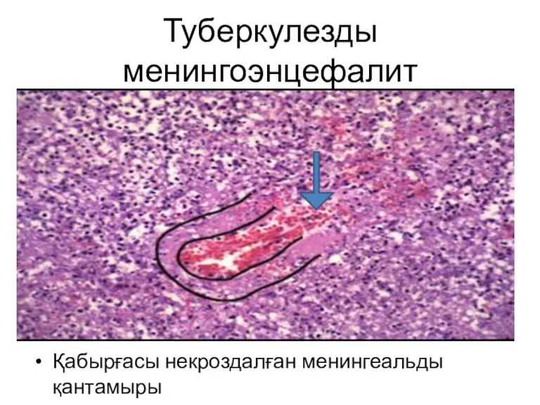 Туберкулезды менингоэнцефалит Қабырғасы некроздалған менингеальды қантамыры