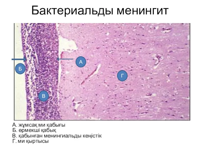 Бактериальды менингит А. жұмсақ ми қабығы Б. өрмекші қабық В. қабынған менингиальды