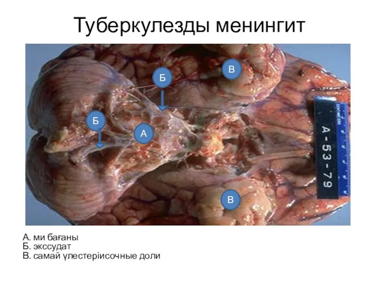 Туберкулезды менингит А. ми бағаны Б. экссудат В. самай үлестеріисочные доли А Б Б В В