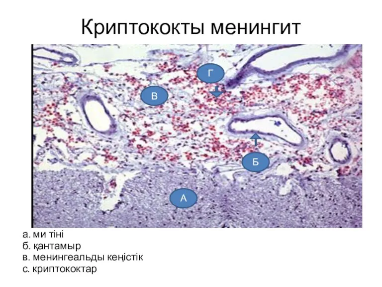 Криптококты менингит а. ми тіні б. қантамыр в. менингеальды кеңістік с. криптококтар А Б В Г