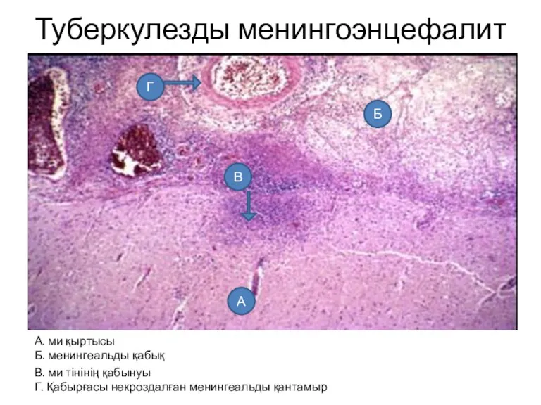 Туберкулезды менингоэнцефалит А. ми қыртысы Б. менингеальды қабық В. ми тінінің қабынуы