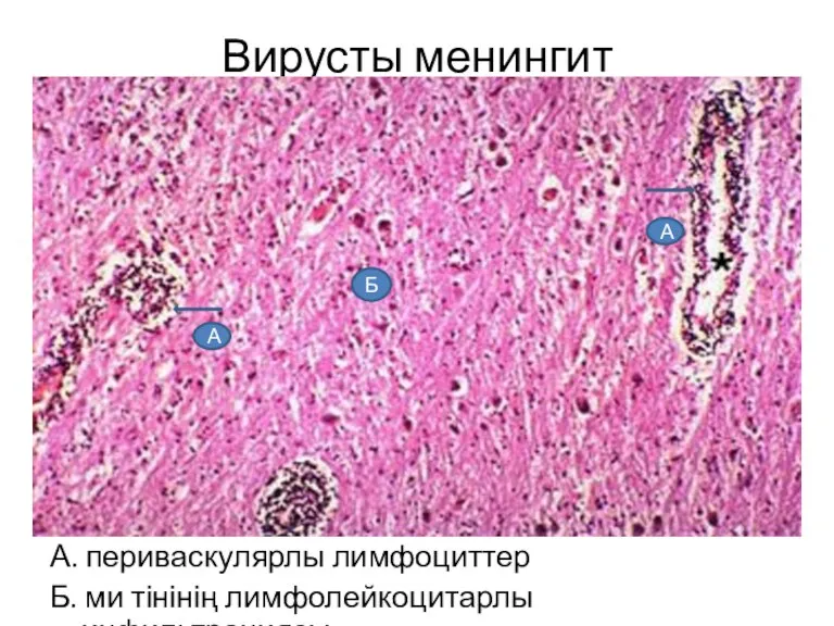 Вирусты менингит А. периваскулярлы лимфоциттер Б. ми тінінің лимфолейкоцитарлы инфильтрациясы А А Б