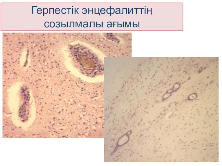 Герпестік энцефалиттің созылмалы ағымы