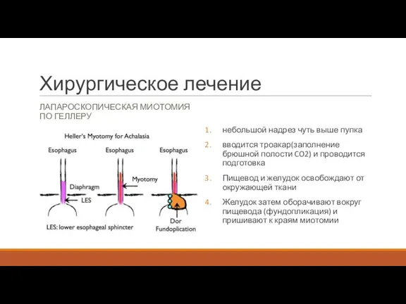 Хирургическое лечение ЛАПАРОСКОПИЧЕСКАЯ МИОТОМИЯ ПО ГЕЛЛЕРУ небольшой надрез чуть выше пупка вводится