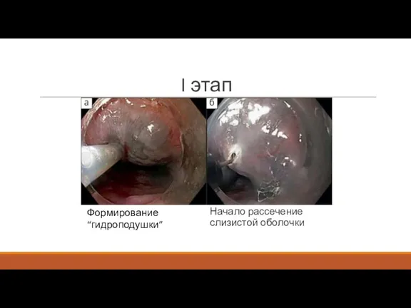 I этап Начало рассечение слизистой оболочки Формирование “гидроподушки”