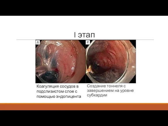I этап Создание тоннеля с завершением на уровне субкардии Коагуляция сосудов в