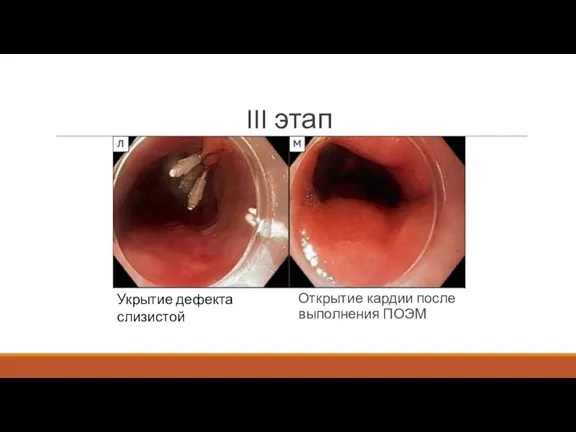 III этап Открытие кардии после выполнения ПОЭМ Укрытие дефекта слизистой