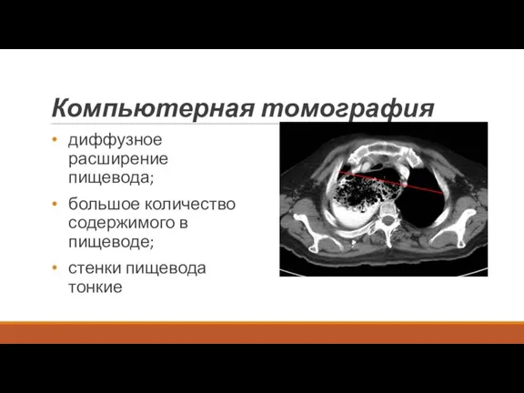 Компьютерная томография диффузное расширение пищевода; большое количество содержимого в пищеводе; стенки пищевода тонкие