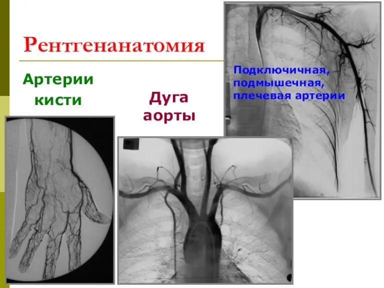 Рентгенанатомия Артерии кисти Дуга аорты Подключичная, подмышечная, плечевая артерии