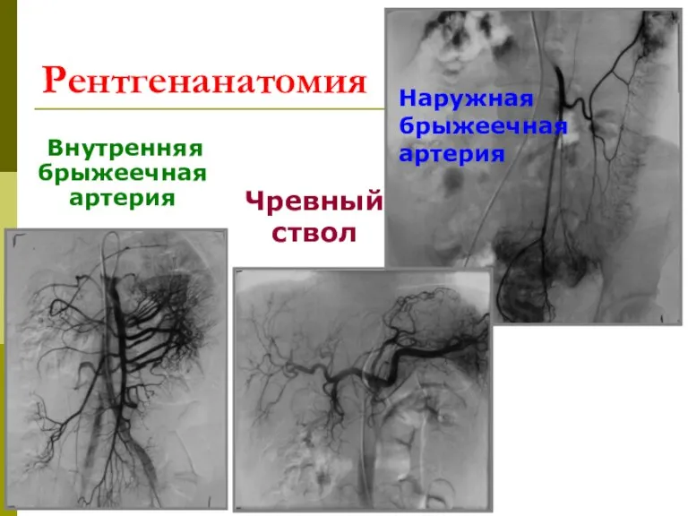 Рентгенанатомия Внутренняя брыжеечная артерия Чревный ствол Наружная брыжеечная артерия