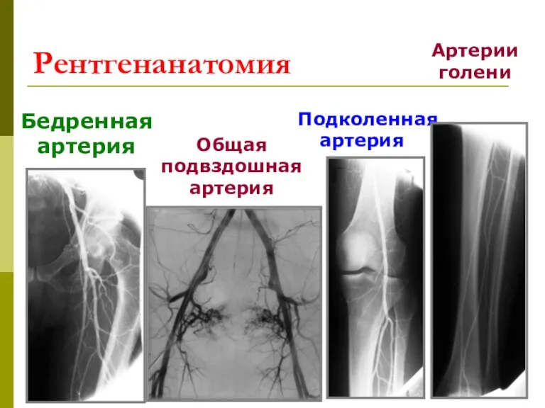 Рентгенанатомия Бедренная артерия Общая подвздошная артерия Подколенная артерия Артерии голени