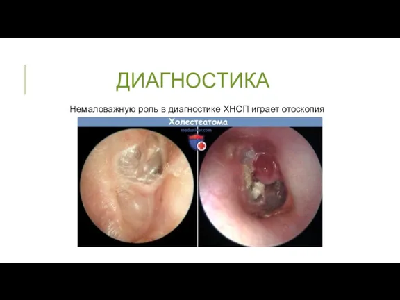 ДИАГНОСТИКА Немаловажную роль в диагностике ХНСП играет отоскопия