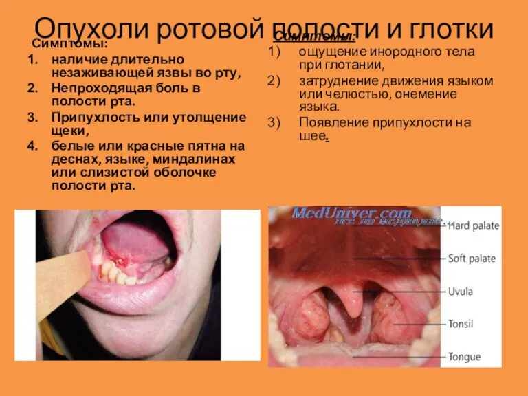 Опухоли ротовой полости и глотки Симптомы: наличие длительно незаживающей язвы во рту,