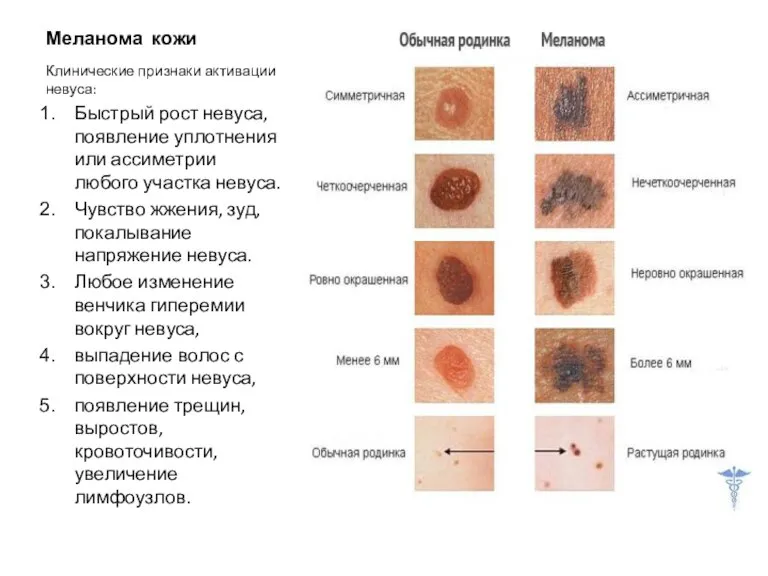 Меланома кожи Клинические признаки активации невуса: Быстрый рост невуса, появление уплотнения или