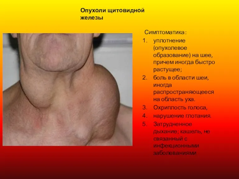 Опухоли щитовидной железы Симптоматика: уплотнение (опухолевое образование) на шее, причем иногда быстро