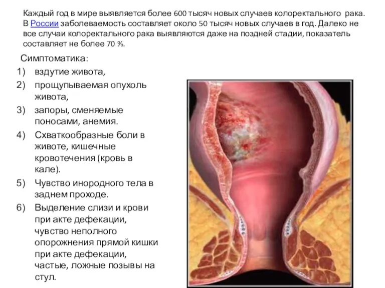 Каждый год в мире выявляется более 600 тысяч новых случаев колоректального рака.