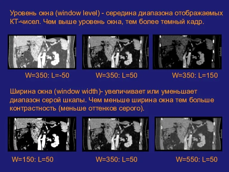 Уровень окна (window level) - середина диапазона отображаемых КТ-чисел. Чем выше уровень