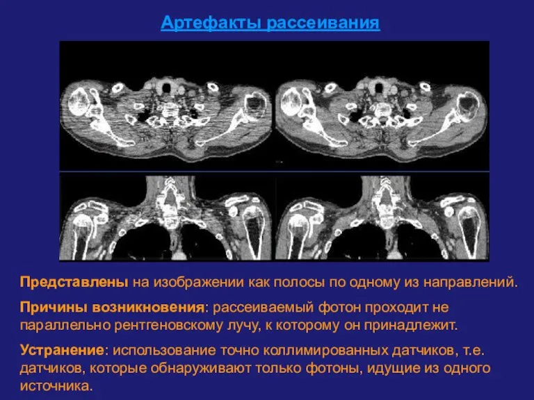 Артефакты рассеивания Представлены на изображении как полосы по одному из направлений. Причины