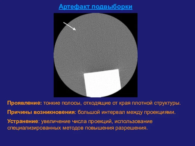 Артефакт подвыборки Проявление: тонкие полосы, отходящие от края плотной структуры. Причины возникновения: