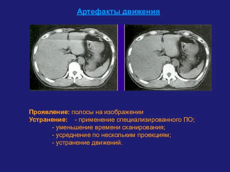 Артефакты движения Проявление: полосы на изображении Устранение: - применение специализированного ПО; -