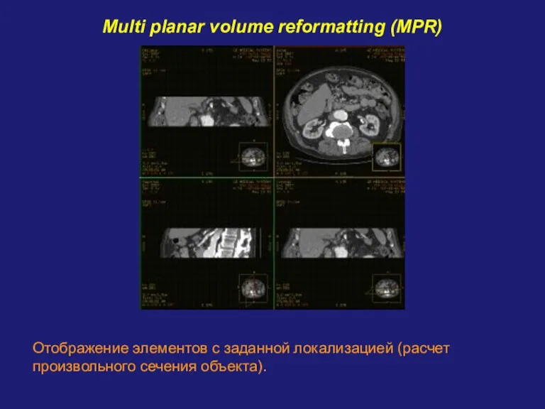 Multi planar volume reformatting (MPR) Отображение элементов с заданной локализацией (расчет произвольного сечения объекта).