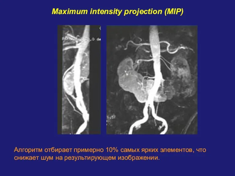 Maximum intensity projection (MIP) Алгоритм отбирает примерно 10% самых ярких элементов, что