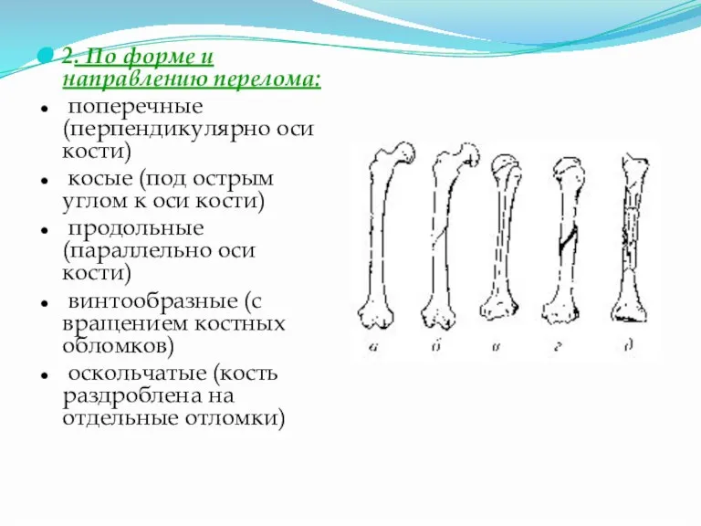 2. По форме и направлению перелома: поперечные (перпендикулярно оси кости) косые (под