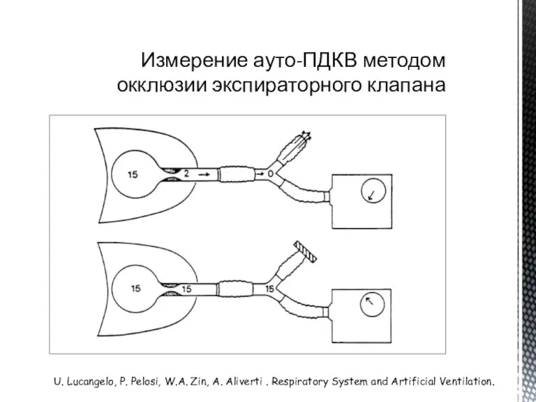 Измерение ауто-ПДКВ методом окклюзии экспираторного клапана U. Lucangelo, P. Pelosi, W.A. Zin,