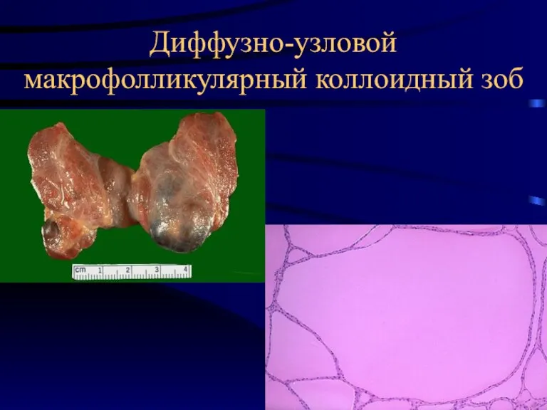 Диффузно-узловой макрофолликулярный коллоидный зоб