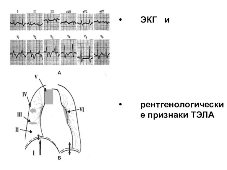 ЭКГ и рентгенологические признаки ТЭЛА