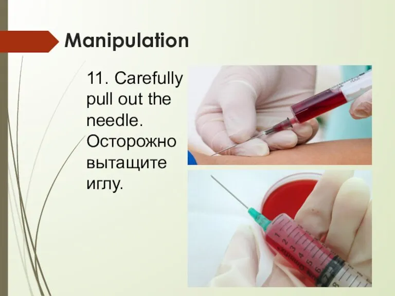Manipulation 11. Carefully pull out the needle. Осторожно вытащите иглу.
