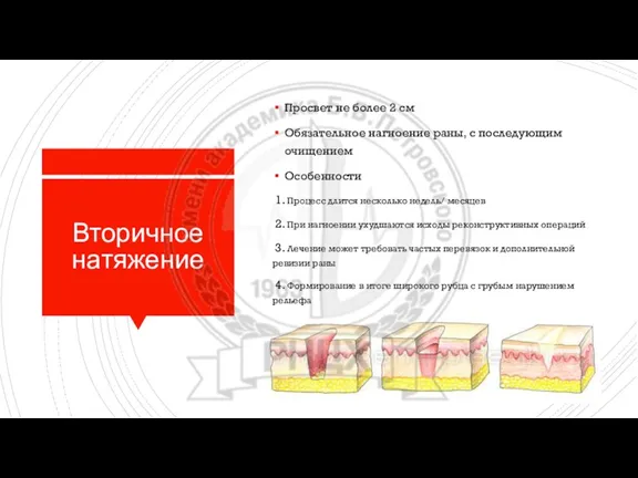 Вторичное натяжение Просвет не более 2 см Обязательное нагноение раны, с последующим