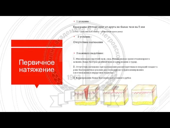 Первичное натяжение 1 условие : Края раны отстоят друг от друга не