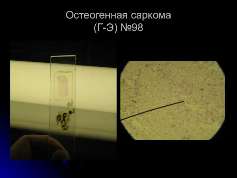 Остеогенная саркома (Г-Э) №98