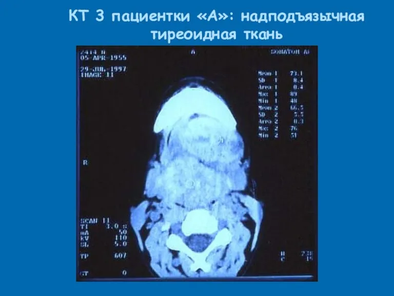 КТ 3 пациентки «А»: надподъязычная тиреоидная ткань