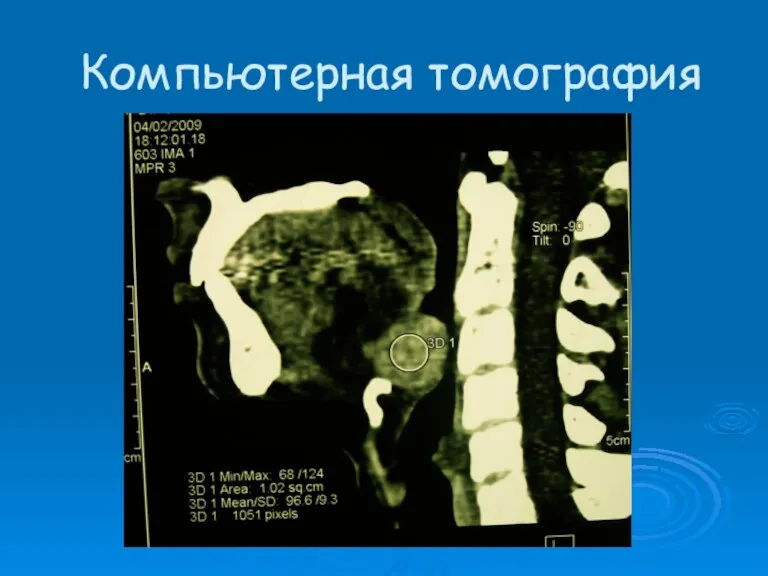 Компьютерная томография